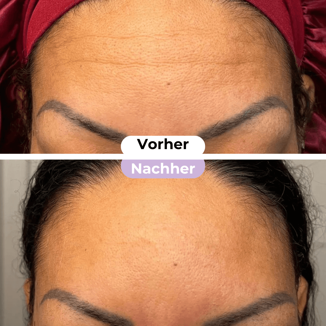 ScarRelief™ | Silikon-Narbenpflaster